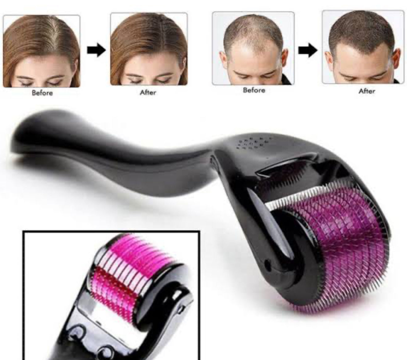 Derma Roller
